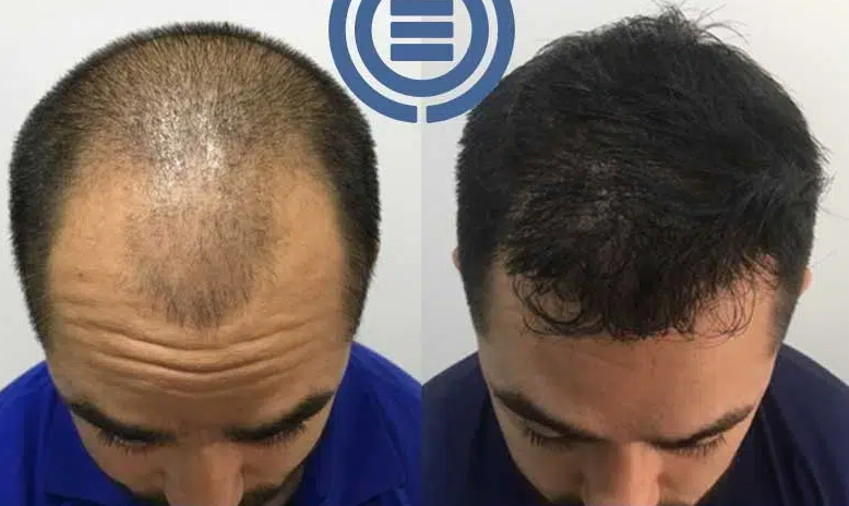 before and after hair transplantion